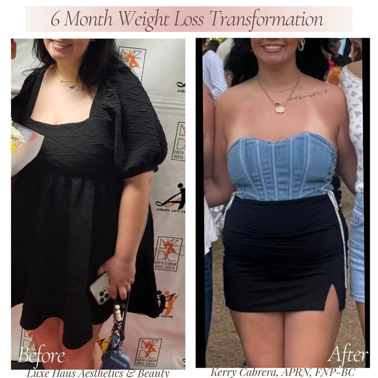 Medical weight loss before and after at Luxe Haus Aesthetics & Beauty in Coral Springs, FL.