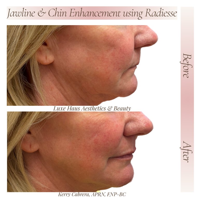 Dermal filler before and after at Luxe Haus Aesthetics & Beauty in Coral Springs, FL.