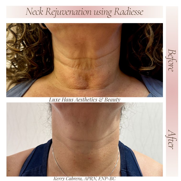 Dermal filler before and after at Luxe Haus Aesthetics & Beauty in Coral Springs, FL.