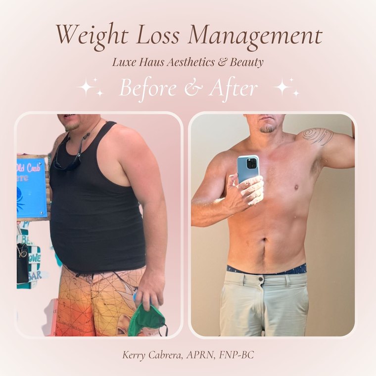 Medical weight loss before and after at Luxe Haus Aesthetics & Beauty in Coral Springs, FL.