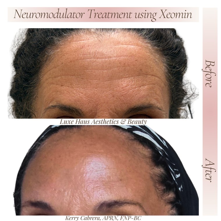Botox / neuromodulator before and after at Luxe Haus Aesthetics & Beauty in Coral Springs, FL.