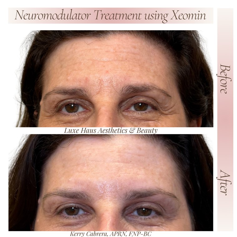 Botox / neuromodulator before and after at Luxe Haus Aesthetics & Beauty in Coral Springs, FL.