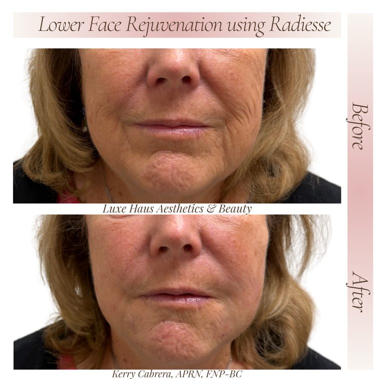 Dermal filler before and after at Luxe Haus Aesthetics & Beauty in Coral Springs, FL.