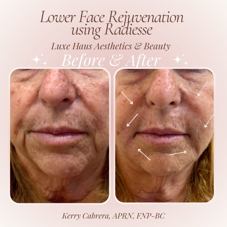 Dermal filler before and after at Luxe Haus Aesthetics & Beauty in Coral Springs, FL.